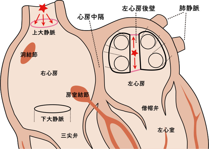 心臓アブレーション後の長期的な見通し